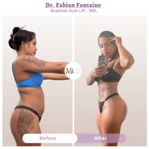 Before and after Brazilian Butt Lift transformation at My Cosmetic Surgery Miami by Dr. Fabian Fontaine, showing body contouring results from a side view.