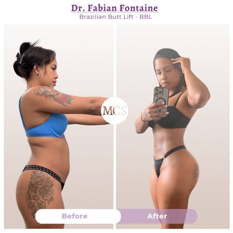Before and after Brazilian Butt Lift transformation at My Cosmetic Surgery Miami by Dr. Fabian Fontaine, showing body contouring results from a side view.