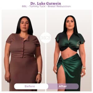 Before and after cosmetic surgery transformation at My Cosmetic Surgery Miami by Dr. Luke Gutwein, showing body contouring results after BBL, tummy tuck, and breast reduction.