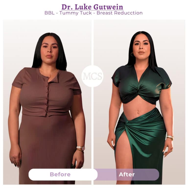 Before and after cosmetic surgery transformation at My Cosmetic Surgery Miami by Dr. Luke Gutwein, showing body contouring results after BBL, tummy tuck, and breast reduction.