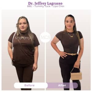 Before and after cosmetic surgery transformation at My Cosmetic Surgery Miami by Dr. Jeffrey LaGrasso, showing BBL, tummy tuck, and chin liposuction results.