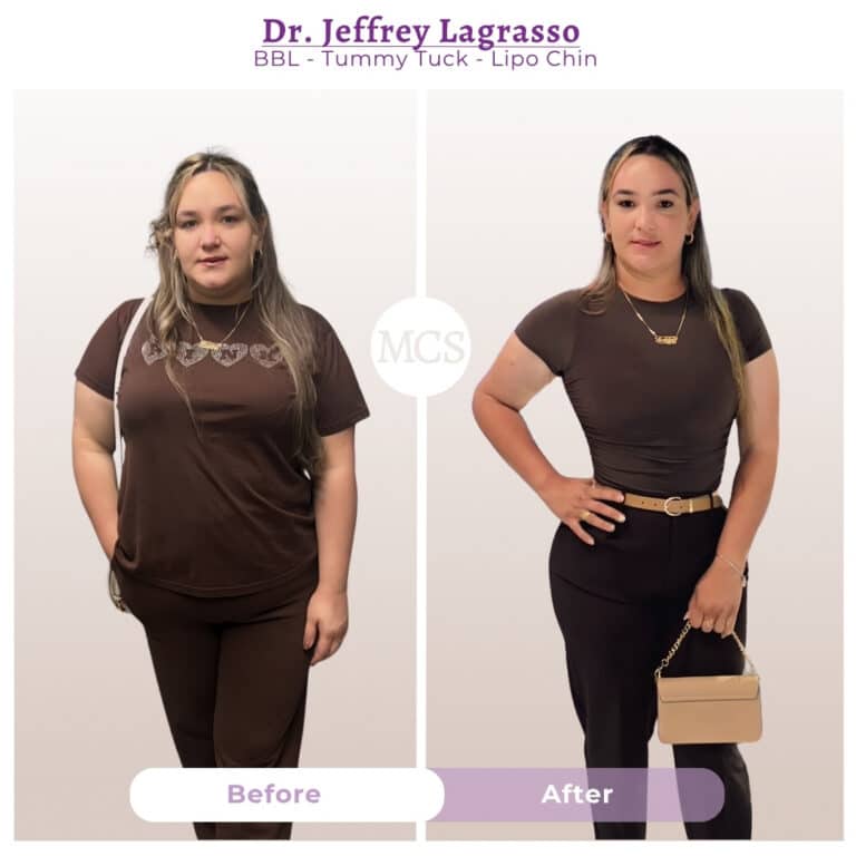 Before and after cosmetic surgery transformation at My Cosmetic Surgery Miami by Dr. Jeffrey LaGrasso, showing BBL, tummy tuck, and chin liposuction results.
