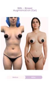 Before and after results of a Brazilian Butt Lift (BBL) and gel breast augmentation, showing enhanced breast volume, improved body contours, a more defined waistline, and fuller curves.