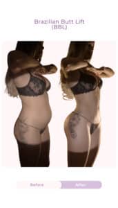Side-view before and after results of a Brazilian Butt Lift (BBL) performed by Dr. Luke Gutwein, showing enhanced buttock projection, improved body contour, and a more defined waist-to-hip proportion.
