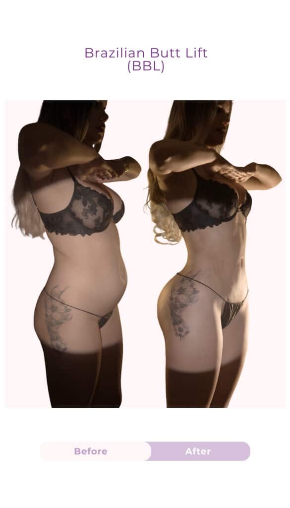 Side-view before and after results of a Brazilian Butt Lift (BBL) performed by Dr. Luke Gutwein, showing enhanced buttock projection, improved body contour, and a more defined waist-to-hip proportion.