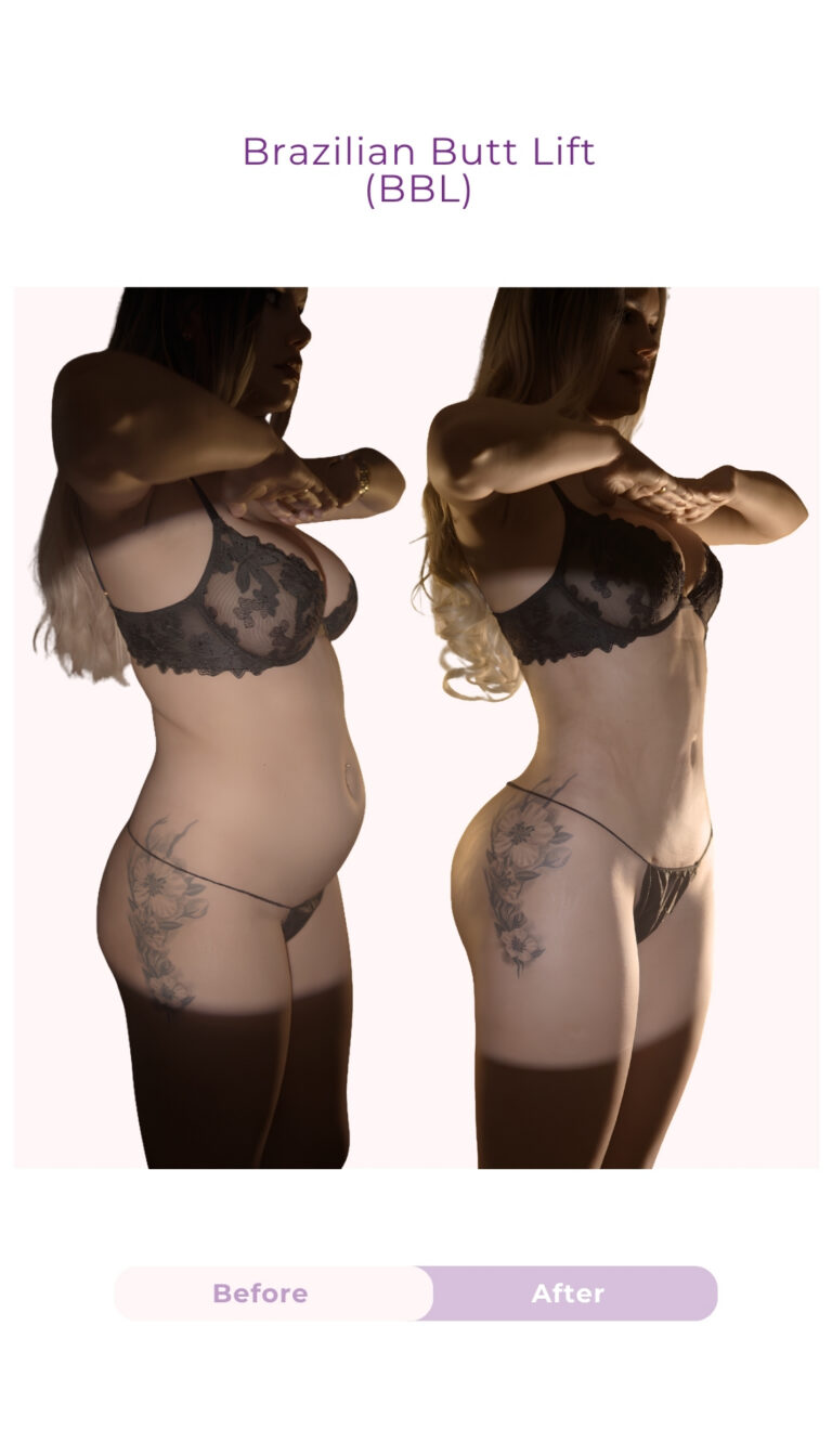 Side-view before and after results of a Brazilian Butt Lift (BBL) performed by Dr. Luke Gutwein, showing enhanced buttock projection, improved body contour, and a more defined waist-to-hip proportion.