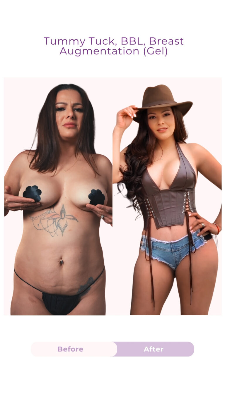 Before and after results of a tummy tuck, Brazilian Butt Lift (BBL), and gel breast augmentation performed by Dr. Jeffrey Lagrasso, showing a flatter abdomen, enhanced breast volume, improved waist definition, and fuller body contours.