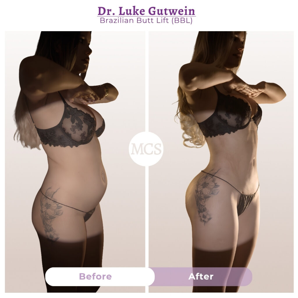 Before and after results of a Brazilian Butt Lift (BBL) performed by Dr. Luke Gutwein, showing improved waist definition, enhanced buttock projection, and a more balanced body contour from the side profile.