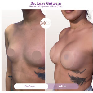 Before and after breast augmentation results performed by Dr. Luke Gutwein using gel implants, showing increased breast volume, improved upper-pole fullness, and enhanced overall breast shape and projection.