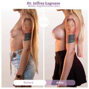Before and after breast augmentation results performed by Dr. Jeffrey Lagrasso using gel implants, showing increased breast volume, enhanced projection, and improved overall breast contour from a side-profile view.