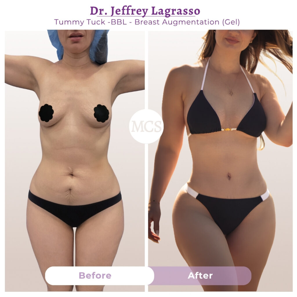 Before and after results of a tummy tuck, Brazilian Butt Lift (BBL), and breast augmentation with gel implants performed by Dr. Jeffrey Lagrasso, showing a flatter abdomen, enhanced breast volume, improved waist definition, and more balanced body contours.