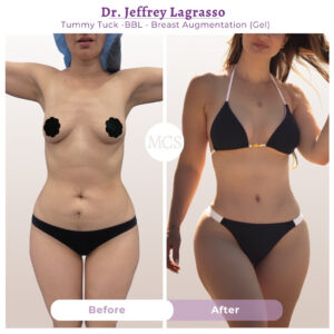 Before and after results of a tummy tuck, Brazilian Butt Lift (BBL), and breast augmentation with gel implants performed by Dr. Jeffrey Lagrasso, showing a flatter abdomen, enhanced breast volume, improved waist definition, and more balanced body contours.