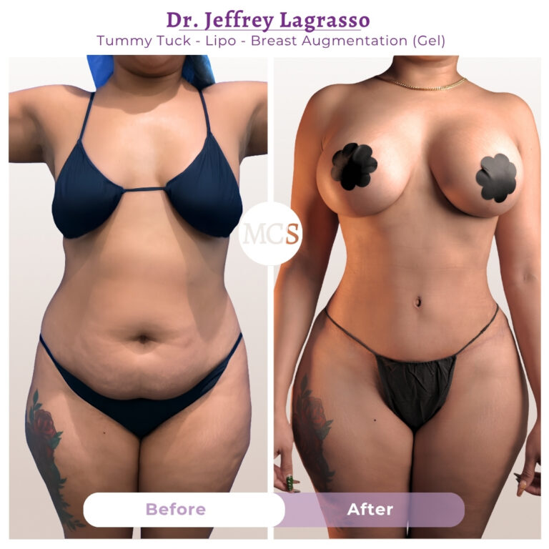 Before and after results of a tummy tuck, liposuction, and breast augmentation with gel implants performed by Dr. Jeffrey Lagrasso, showing a flatter abdomen, improved waist definition, enhanced breast volume, and more balanced body contours.