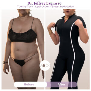 Before and after results of a tummy tuck, liposuction, and breast reduction performed by Dr. Jeffrey Lagrasso, showing improved abdominal contour, a more defined waistline, reduced breast volume, and a more balanced body silhouette.