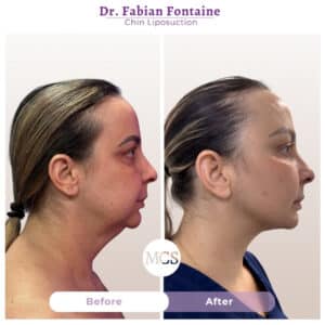 Side-profile before and after results of chin liposuction performed by Dr. Fabian Fontaine, showing a more defined jawline, improved neck contour, and enhanced facial profile.