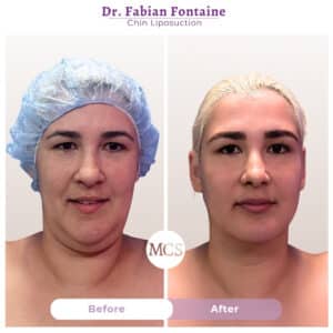 Front-view before and after results of chin liposuction performed by Dr. Fabian Fontaine, showing a more refined jawline, reduced fullness beneath the chin, and improved facial definition.