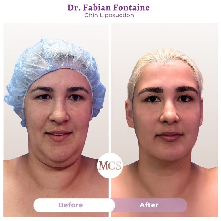 Front-view before and after results of chin liposuction performed by Dr. Fabian Fontaine, showing a more refined jawline, reduced fullness beneath the chin, and improved facial definition.