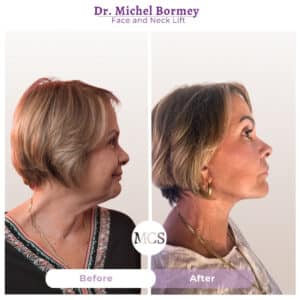 Side-profile before and after results of a face and neck lift performed by Dr. Michel Bormey, showing improved jawline definition, a smoother neck contour, and a more refreshed facial appearance.
