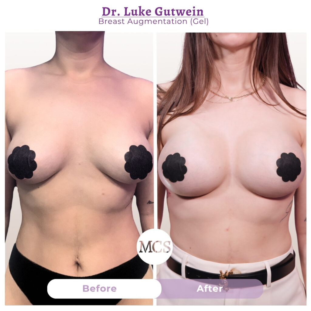 Front-view before and after breast augmentation results performed by Dr. Luke Gutwein, showing increased breast volume, improved fullness, and enhanced upper-pole projection while maintaining balanced body proportions.