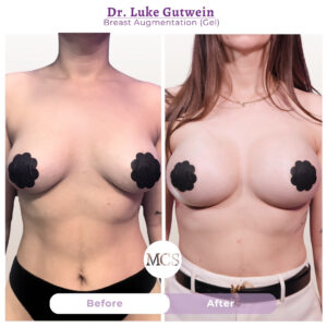 Front-view before and after breast augmentation results performed by Dr. Luke Gutwein, showing increased breast volume, improved fullness, and enhanced upper-pole projection while maintaining balanced body proportions.