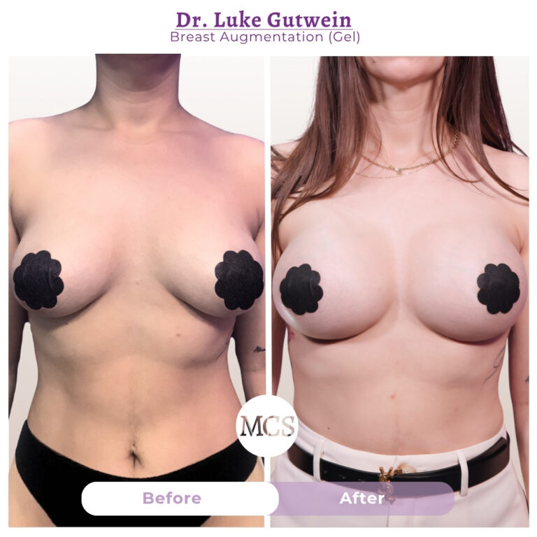 Front-view before and after breast augmentation results performed by Dr. Luke Gutwein, showing increased breast volume, improved fullness, and enhanced upper-pole projection while maintaining balanced body proportions.