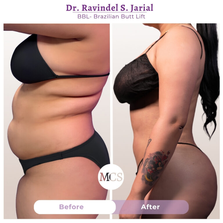 Side-view before and after Brazilian Butt Lift (BBL) results performed by Dr. Ravinder S. Jarial, showing improved waist contour, reduced abdominal fullness, and enhanced buttock projection for a more balanced silhouette.