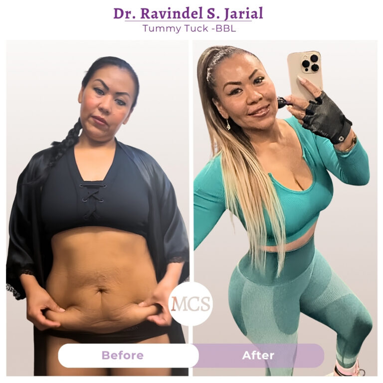 Before and after results of a tummy tuck and Brazilian Butt Lift performed by Dr. Ravindel S. Jarial, showing a flatter abdomen, improved waist definition, and enhanced body contours.