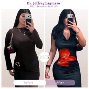 Before and after Brazilian Butt Lift (BBL) results performed by Dr. Jeffrey LaGrasso, showing enhanced body contours, a more defined waistline, and increased buttock projection in a patient photographed in fitted dresses.