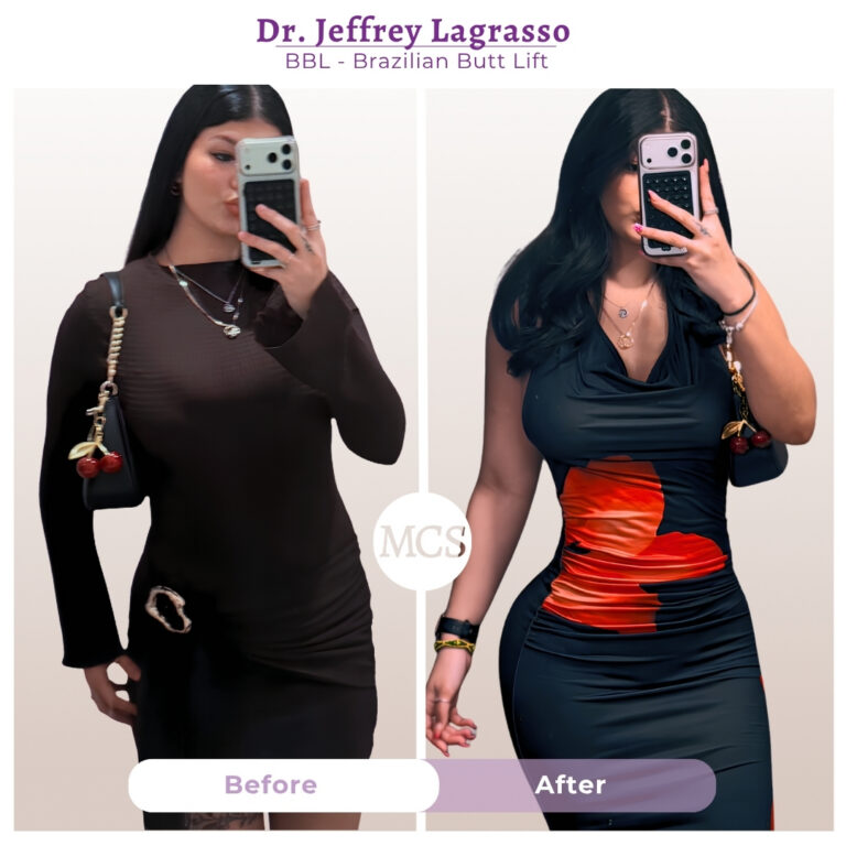 Before and after Brazilian Butt Lift (BBL) results performed by Dr. Jeffrey LaGrasso, showing enhanced body contours, a more defined waistline, and increased buttock projection in a patient photographed in fitted dresses.
