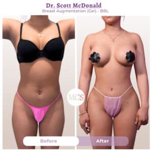 Front-view before and after results of breast augmentation with gel implants and Brazilian Butt Lift (BBL) performed by Dr. Scott McDonald, showing enhanced breast fullness, improved body contours, and a more balanced silhouette.