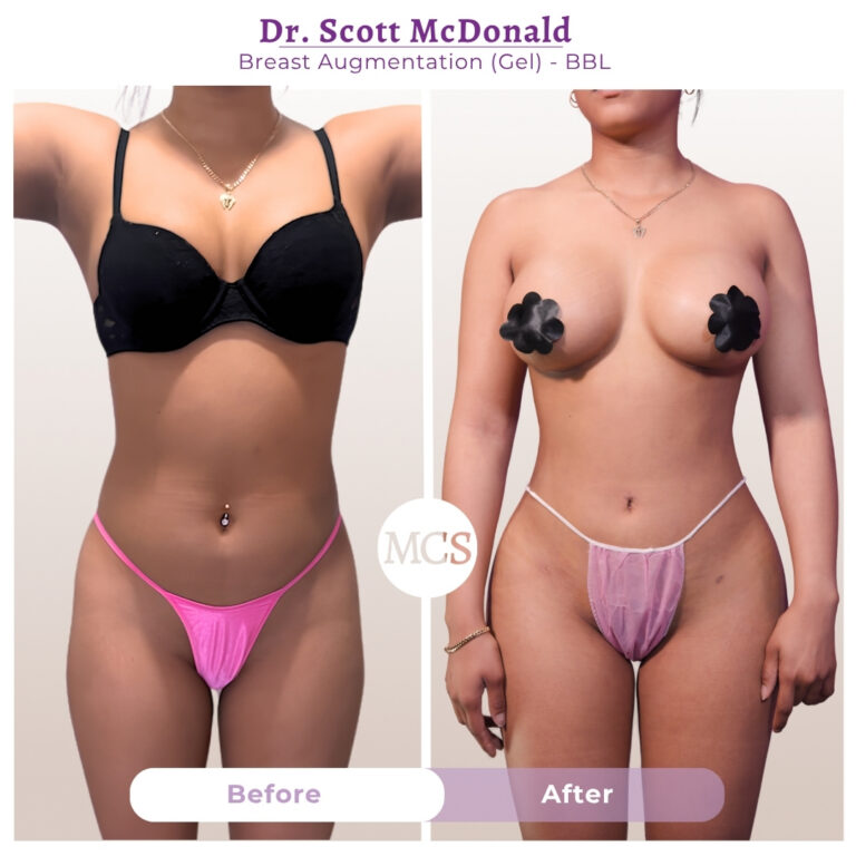 Front-view before and after results of breast augmentation with gel implants and Brazilian Butt Lift (BBL) performed by Dr. Scott McDonald, showing enhanced breast fullness, improved body contours, and a more balanced silhouette.