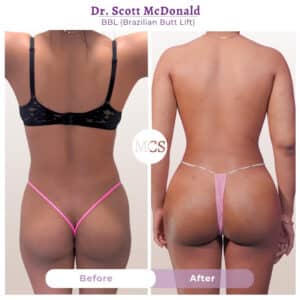 Rear-view before and after Brazilian Butt Lift (BBL) results performed by Dr. Scott McDonald, showing enhanced buttock volume, improved projection, and a more contoured lower-body silhouette.