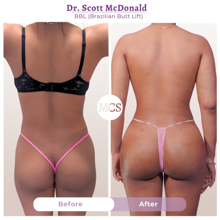 Rear-view before and after Brazilian Butt Lift (BBL) results performed by Dr. Scott McDonald, showing enhanced buttock volume, improved projection, and a more contoured lower-body silhouette.