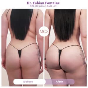 Rear-view before and after Brazilian Butt Lift (BBL) results performed by Dr. Fabian Fontaine, showing enhanced buttock volume, improved projection, and a more sculpted lower-body contour.