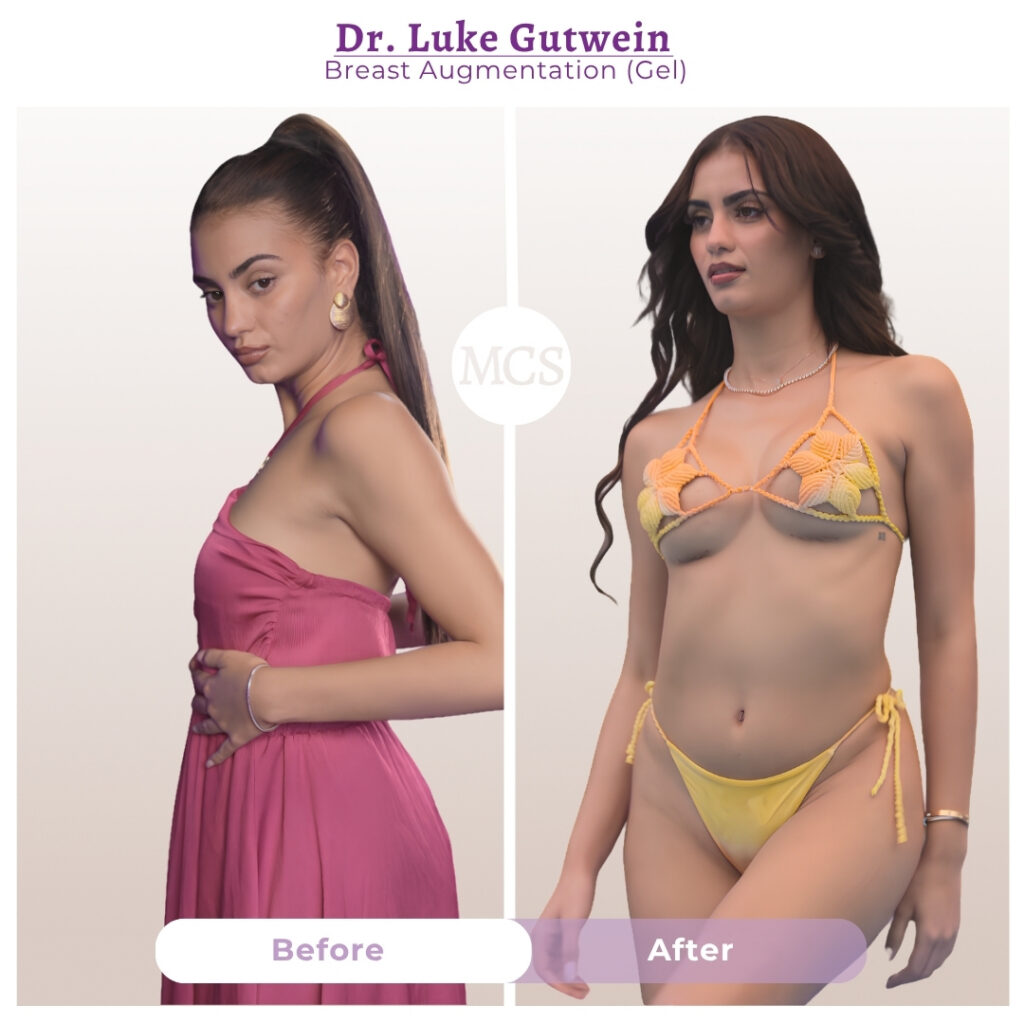 Before and after breast augmentation results performed by Dr. Luke Gutwein, showing increased breast fullness, enhanced projection, and improved body proportions while maintaining a balanced appearance.