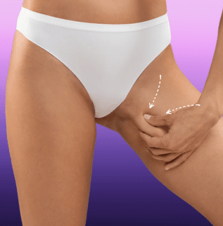 Woman holding the skin of her inner thigh, with arrows illustrating the direction of a thigh lift.